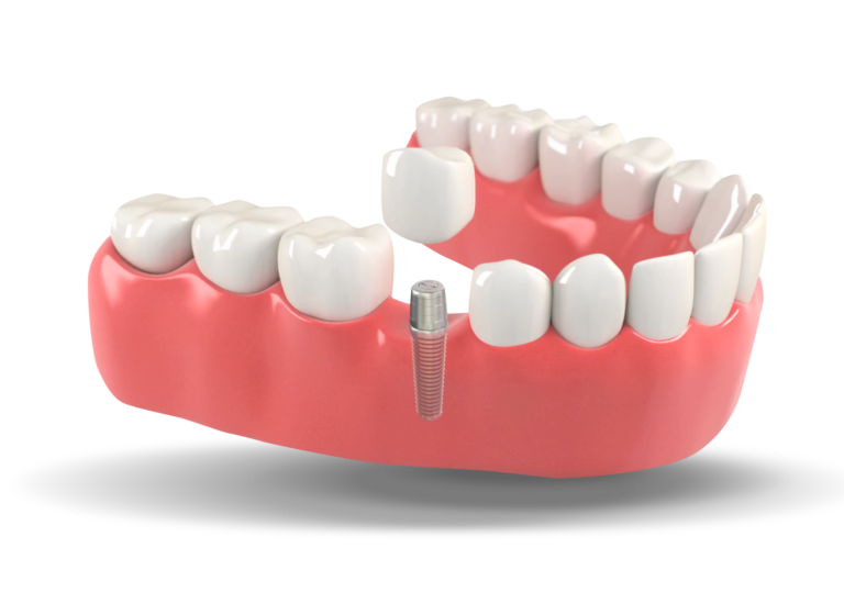 Dental implant