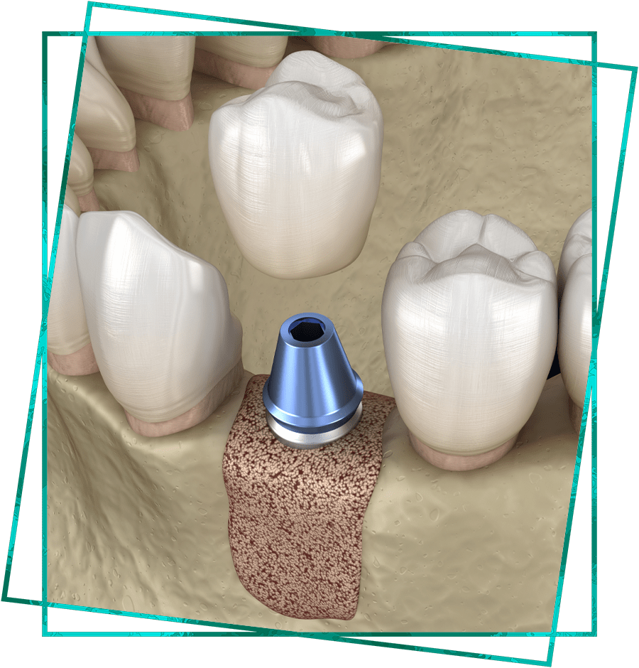 bone graft graphic