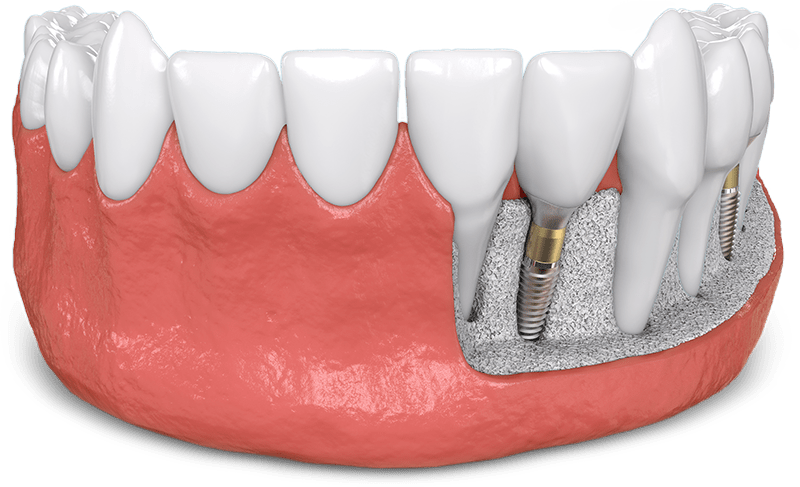 bone grafting model