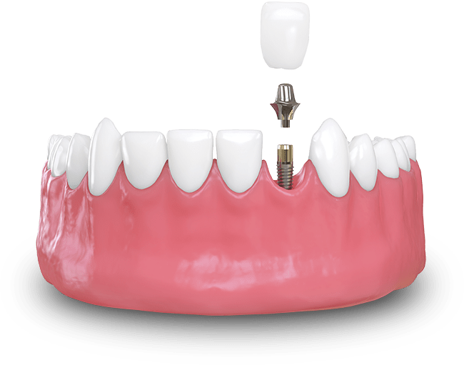 dental implant model
