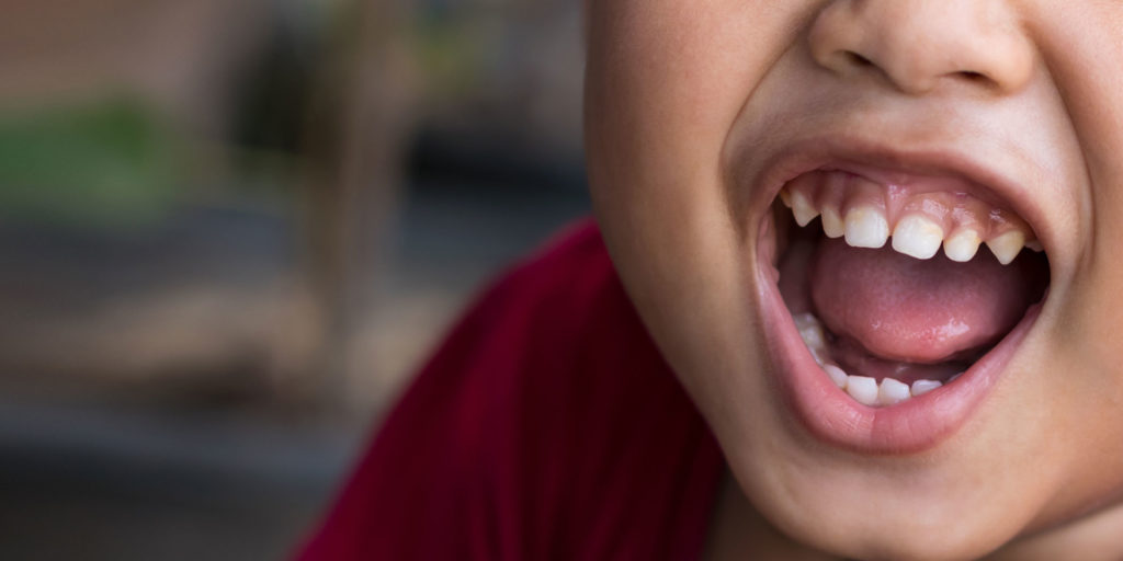 dental patient in need of frenectomy