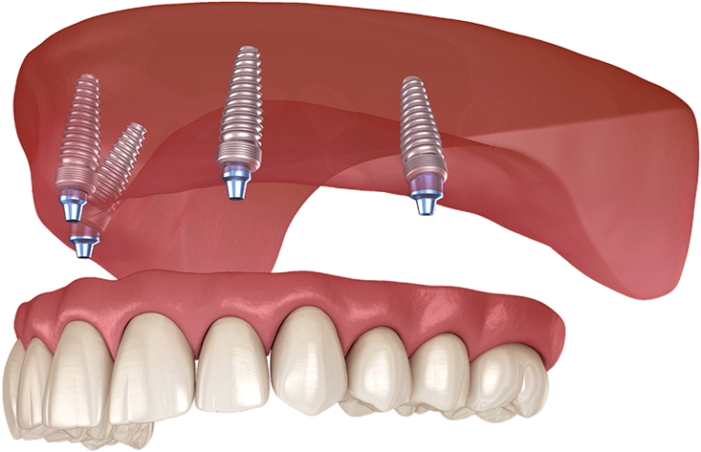 full arch dental implants model