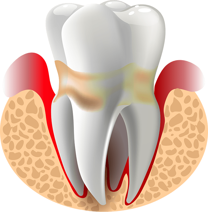 gum disease graphic