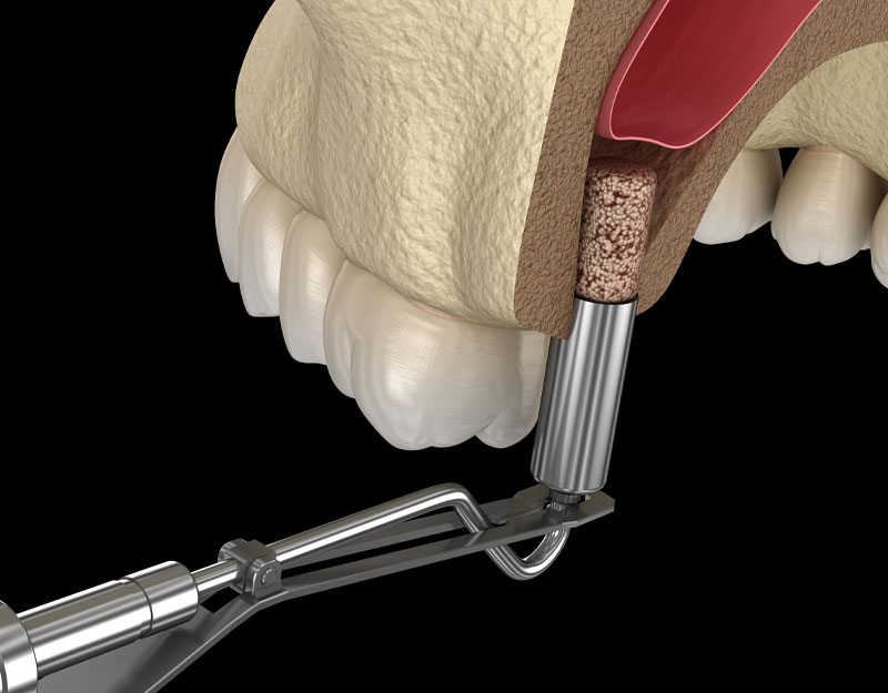 sinus lift graphic