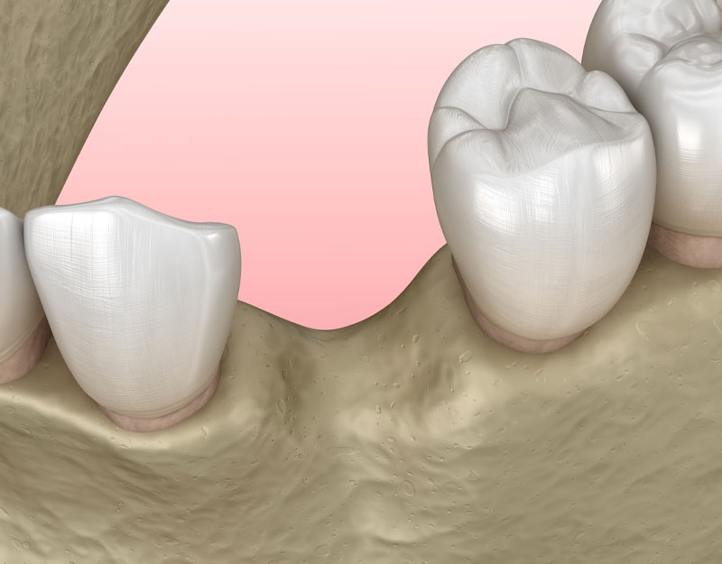 socket preservation