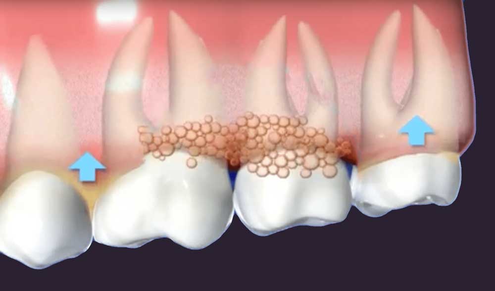 a diagram depicting gums affected by periodontal disease