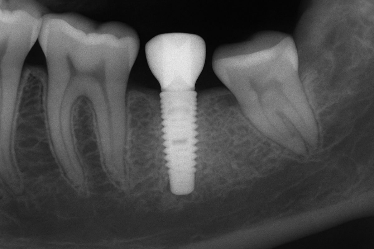 An x-ray showing a tooth implant graft integrating into the jawbone, highlighting the increased bone density around the implant site. No text on the image.