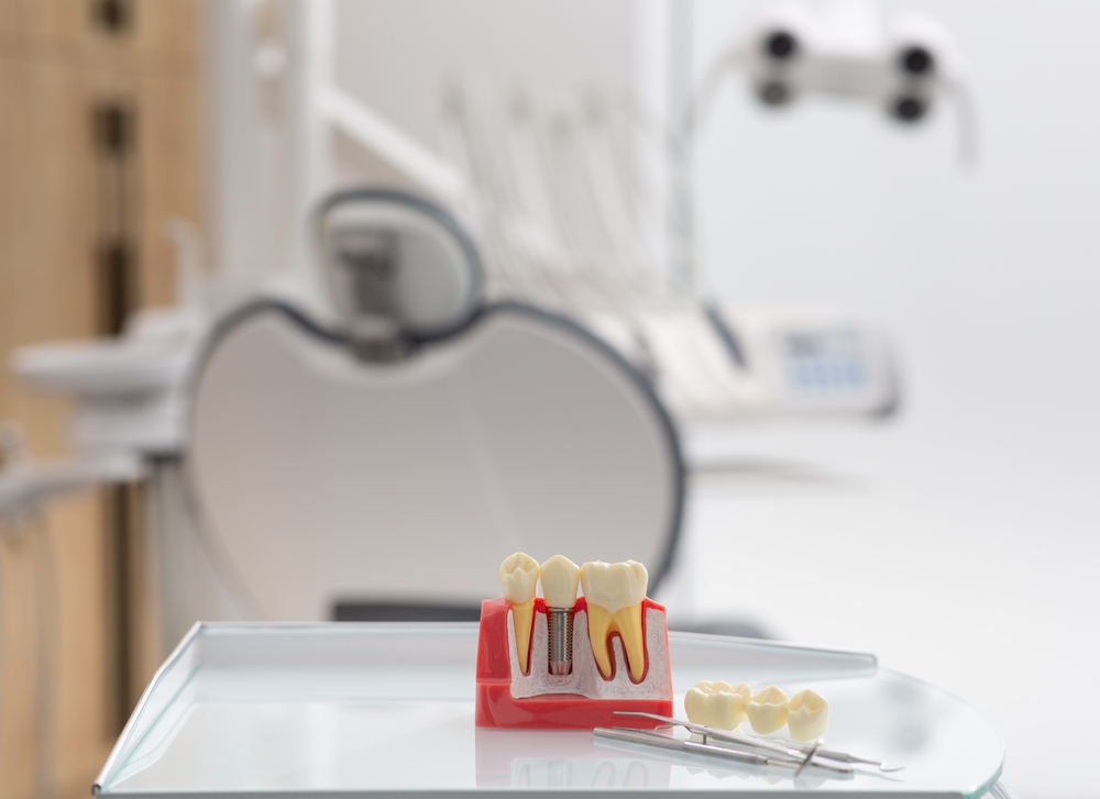 Close up image of dental implants in a jaw, with one highlighted and a small meter showing "30 years". The text overlay on the image says "How Long Do Dental Implants Last?".